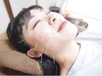 根津のはり悠鍼灸院/《美容鍼コース》