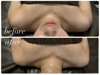 ビノスビューティー(vinos.beauty)/症例写真　巻き肩　小倉エステ