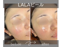 サロンドボーテアリス (Salon de beaute ALICE)の雰囲気（韓国最新美容！肌負担の無いララピールで極上のツヤ肌★）