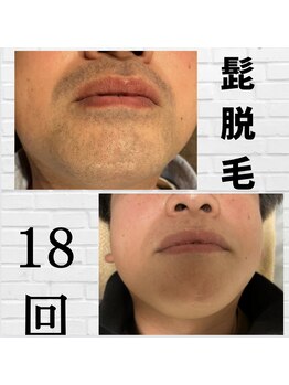 ピュアン(PyuAn)/ヒゲ脱毛☆before→after