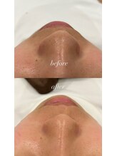 エレニア(Elenear)/お顔脱毛がすごい！