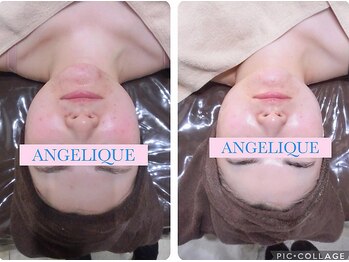 アンジェリーク/メグミ絶賛肌育ハーブピーリング