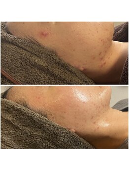 モア(moa)/ハーブピーリング3回目