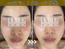 ラヴレボーテ(La Vraie Beaute)の雰囲気(岸和田久米田/10回のエステよりも1回のハーブピーリング2回症例)