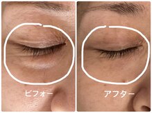 ノーブル シャット Noble Chate/たるみケア・1ヶ月後