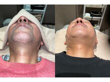 アイスタイル(i-style)/ひげ脱毛♪