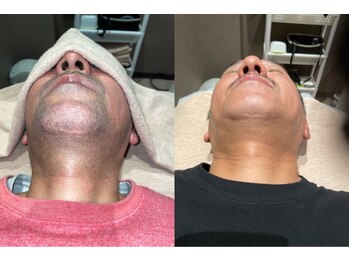 アイスタイル(i-style)/ひげ脱毛♪