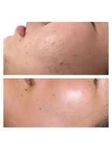 ヴィヴ コレビ(VIV COREBI)/10代のニキビケア