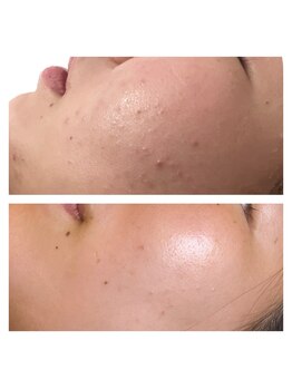 ヴィヴ コレビ(VIV COREBI)/10代のニキビケア