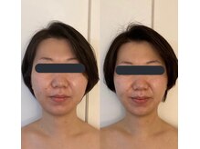 ハイコガオ(HIKOGAO)/小顔矯正40分