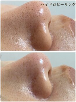 サロンドフルール/ハイドロピーリング