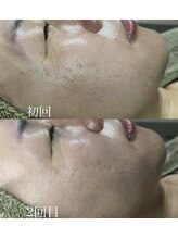 アディ(Adiy)/ビフォーアフター