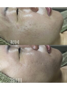 アディ(Adiy)/ビフォーアフター