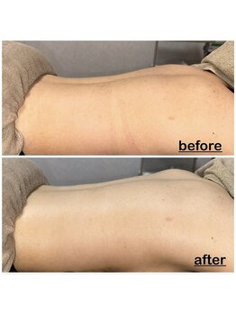 ミニョン(mignon)/今から夏の美肌準備！