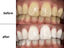 メルヴェイユ/東中野ホワイトニング