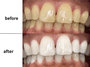 メルヴェイユ/東中野ホワイトニング