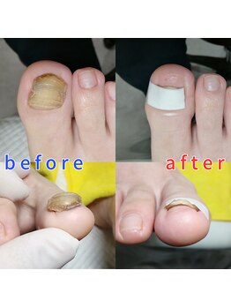 【肥厚・変形爪】ネイル/フット