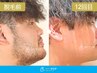 【5月限定】ヒゲ脱毛3部位3回 デビュープラン 初回7,800円（税込）