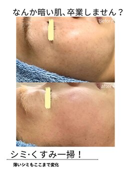 エイチケービューティーサロン(H/K beauty salon)/【くすみ改善】