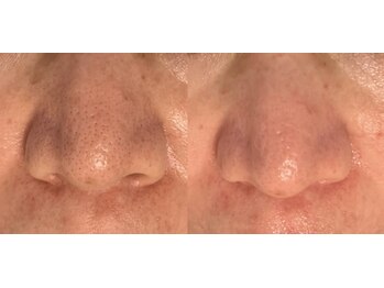 美肌ワークス(美肌works)/効果抜群毛穴ケアお任せください