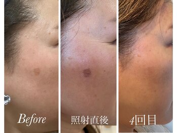 美バストアルファ(美bust α)/【シミ改善】