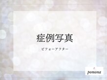 ポモナ 横浜馬車道店(Pomona)/シミケア・シミ改善美肌ケア