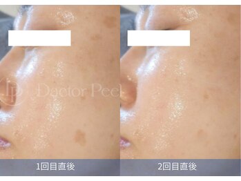 ハーシークレット(Her secret)/ダクトピール+毛穴洗浄