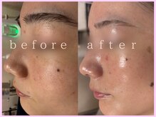 マヤヒメ(mayahime)/REVIハーブピーリング6回