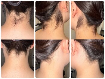 ワイズサロン(Y's salon)/うなじ脱毛