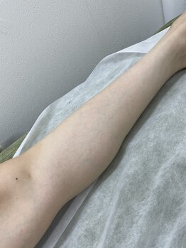 ナノハナ/鹿沼市の全身脱毛のナノハナ