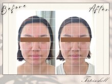 トーティシェル(tortoise shell)/小顔になりたい方必見！