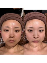 パルティール 渋谷店 partir/コラーゲンの泡でくすみも