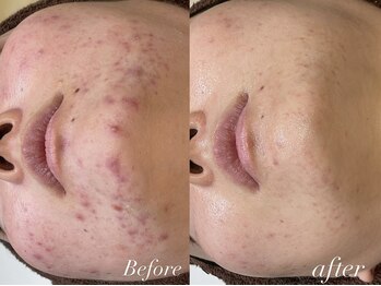 レシェルサロン(Lechelle Salon)/肌質改善ハーブピーリング