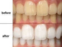 メルヴェイユ/東中野ホワイトニング