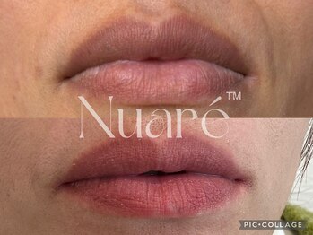 エスビーエス オキナワ(SBS OKINAWA)/シミケア唇モニター様