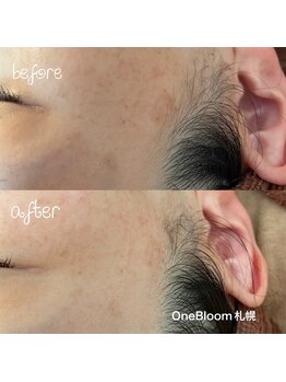 ワンブルーム(OneBloom)/ピンポイントでシミ集中ケア!