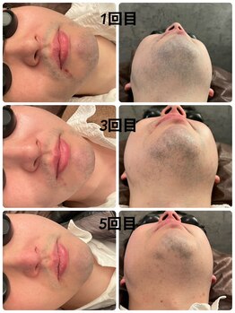 サクロス(Sacloth)/20代後半 順調に経過してます○