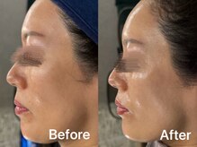 スウィート リリー(Sweet Lily)の雰囲気（エステ版ダーマ【エクソロイド】Before After）