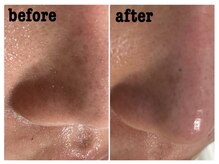 サロン マレ(salon mare)/毛穴洗浄