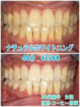 プラチナムビューティー 川口駅前店(PLATINUM BEAUTY)/回数券ご利用で白い歯をキープ◎