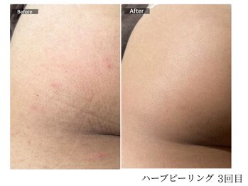 エミルカ 宮崎店(EMILUCA)の写真/【お尻ハーブピーリング】お尻ニキビにお悩みの方へ☆(※女性限定メニュー)見えないとこまでこだわる♪