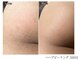 エミルカ 宮崎店(EMILUCA)の写真/【お尻ハーブピーリング】お尻ニキビにお悩みの方へ☆(※女性限定メニュー)見えないとこまでこだわる♪