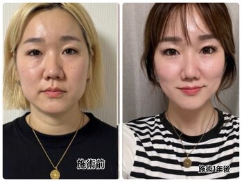 リアン/ダイエット×テラボーラー最強