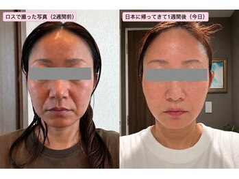 アスエ(ASUE)の写真/気になる部分を集中ケア◎韓国最新・美容液導入で、輝くツヤ肌体験をぜひ♪
