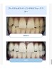 【お試しトーンアップ向け】回数券4回プラン★短期間でトーンUPを目指す方へ
