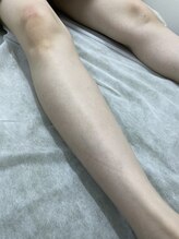 ナノハナ/鹿沼市の全身脱毛のナノハナ