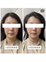 ヴィーライン 恵比寿本院(VeLine)/お客様Before After/小顔効果