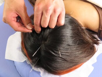 いん鍼灸治療院/＜頭皮への鍼施術＞