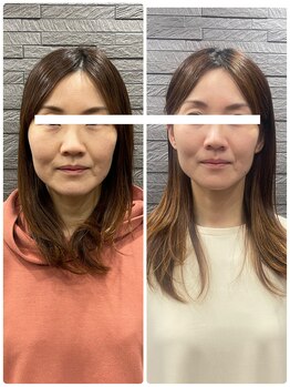 長寿鍼灸院 長寿整骨院/ハリネズミ女優美容鍼効果★