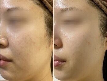 ビ ボーテ(美 Beaute)/REVIハーブピーリング/小顔/美白